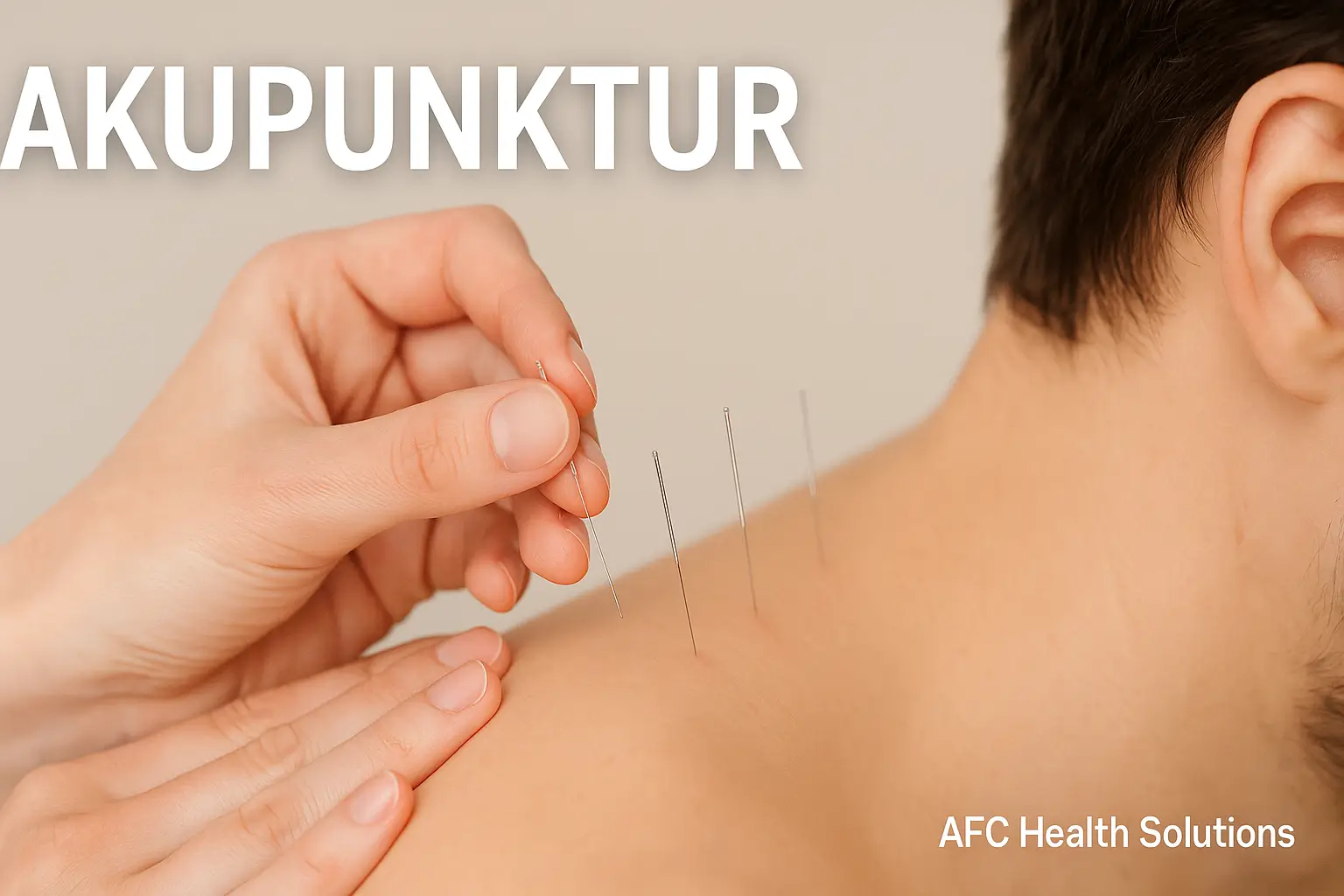 Akupunktur: Terapi Tradisional untuk Kesehatan Holistik