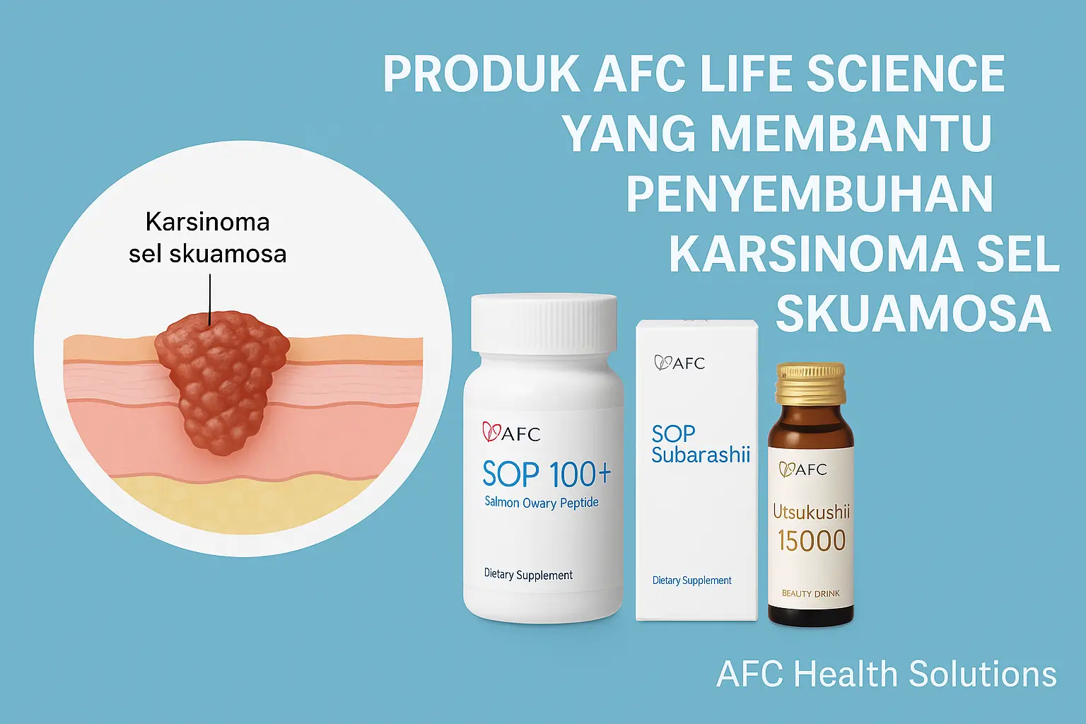 Produk AFC Life Science yang Membantu Penyembuhan Karsinoma Sel Skuamosa